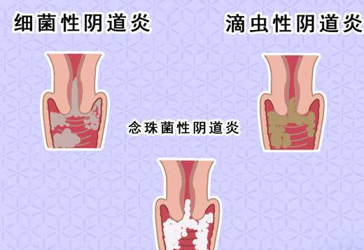 阴道分泌物香蕉视频下载安装剖析什么是细菌性阴道炎