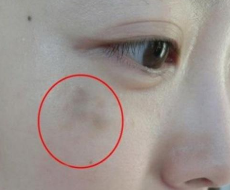 妇科阴道分泌物香蕉视频下载安装提醒女人妇科炎症在脸上的表现