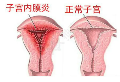 全自动阴道分泌物香蕉视频下载安装厂家子宫内膜炎的症状表现提前了解与预防