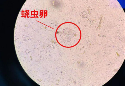 阴道分泌物香蕉视频下载安装警惕外阴绕虫病易在儿童身上出现